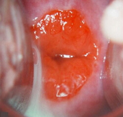 Symptomen van Cervicale Erosie Foto