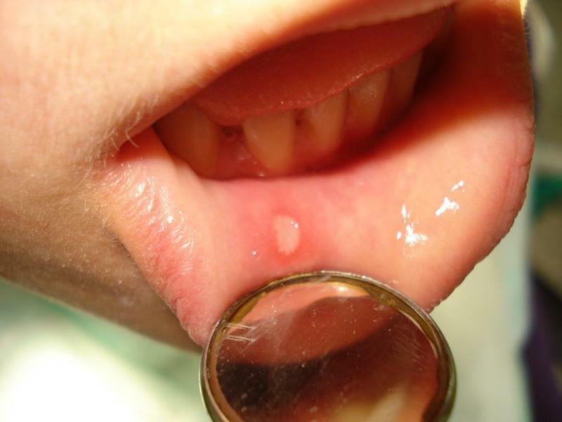 Herpes na notranji strani foto ustnic