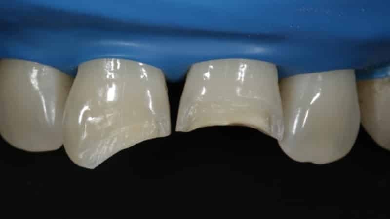 dentes formando: Antes e Depois