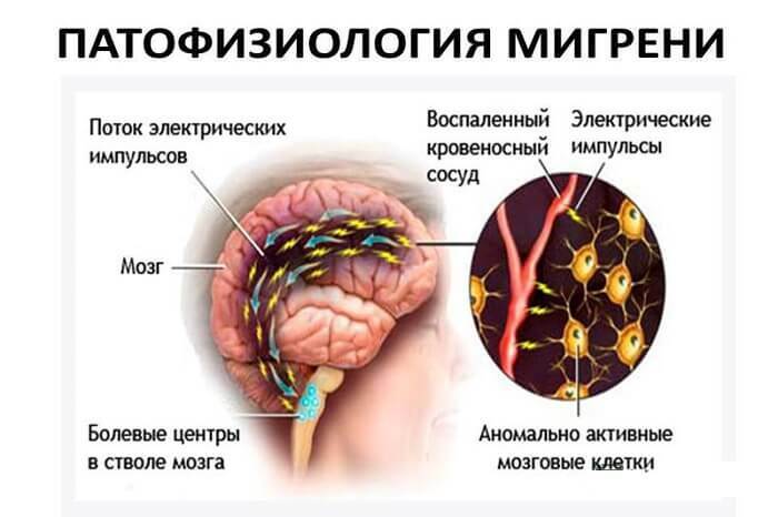 De pathofysiologie van migraine,