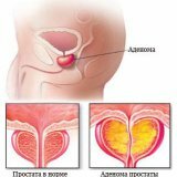 Hyperplasie van de prostaat: etiologie, pathogenese, behandeling