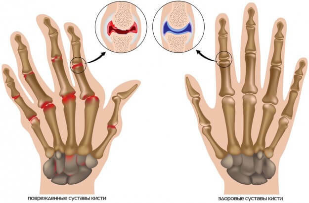 prsty bolení