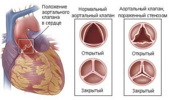 Aorta stenose, symptomer, årsager, nuværende behandlinger