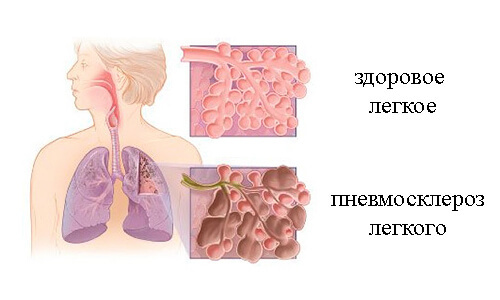 Pulmonary fibrosis: symptoms and treatment