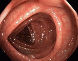 Endoscopia intestinal