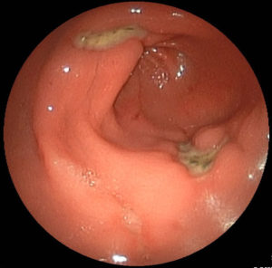 Stomach disease