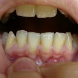 Behandeling van periodontitis met volksmethode