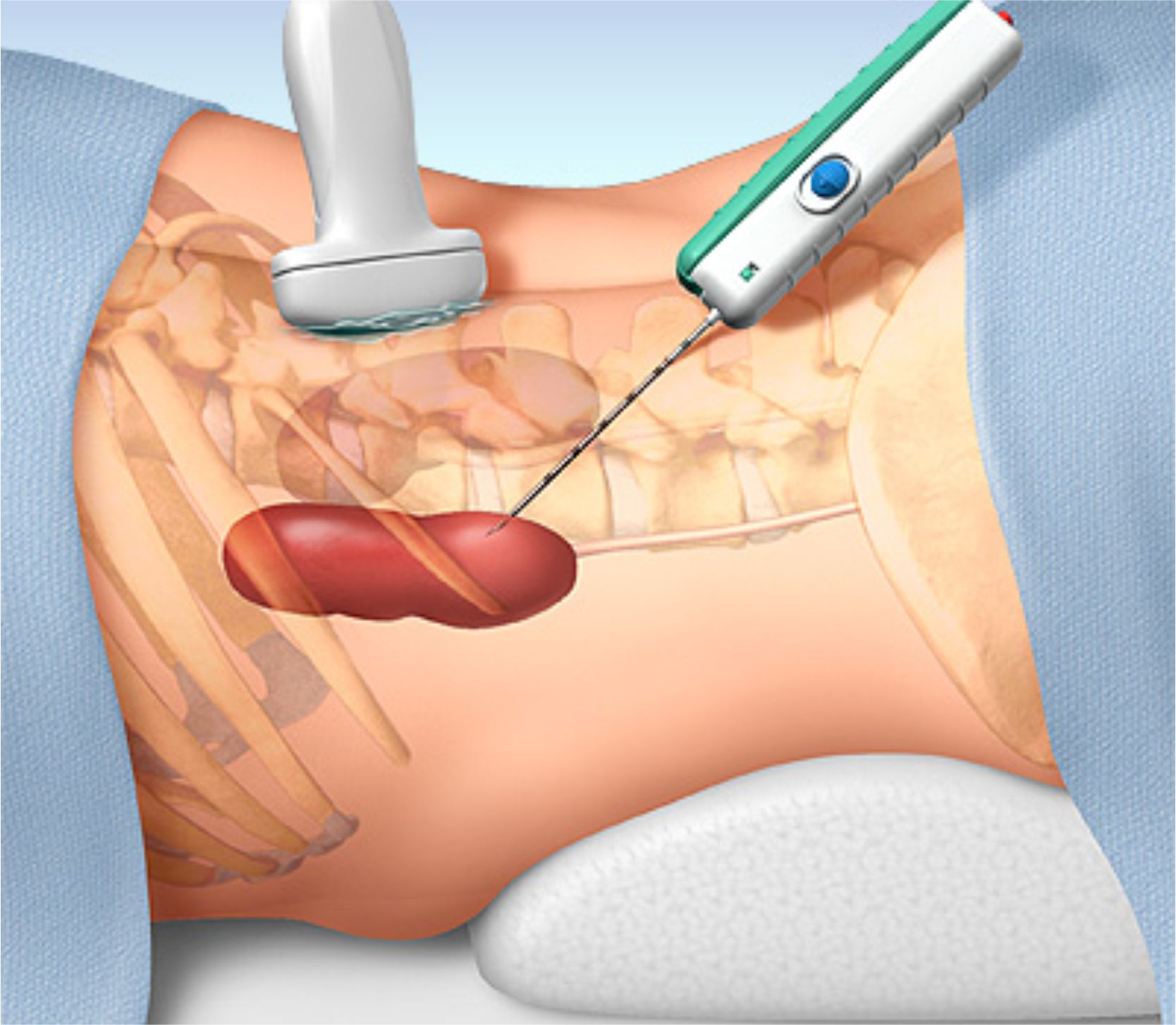 Biopsi studier: hur man gör en biopsi?