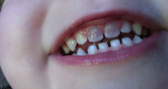 Tetracycline tanden bij kinderen