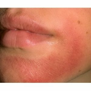 allergische dermatitis, face-to-
