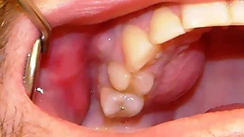 nódulo sob o dente da mandíbula