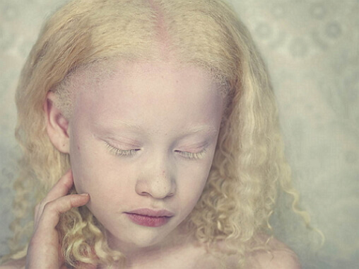 Albino deklica Foto