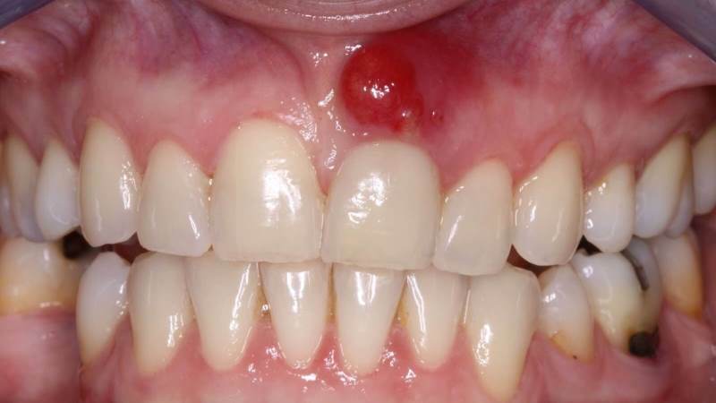 Uszkodzenie błony śluzowej jamy ustnej