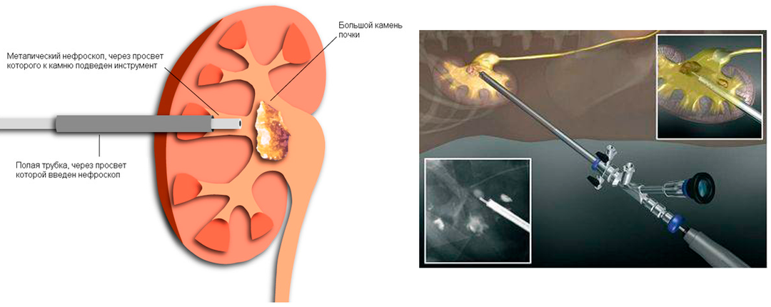 Treatment of kidney stones: features of surgical and conservative treatment of kidney stones