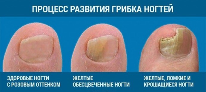 Stages of development of the nail fungus