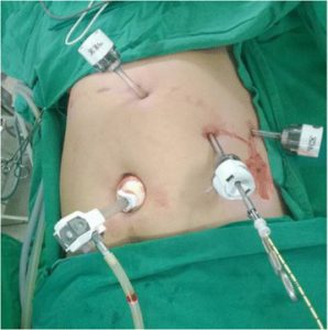 Cholecystectomia