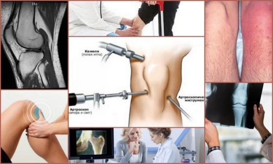 Condromalaci og knæled: årsager, symptomer, diagnose, behandling
