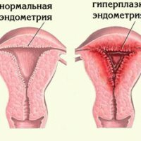 Behandeling van endometriale hyperplasie