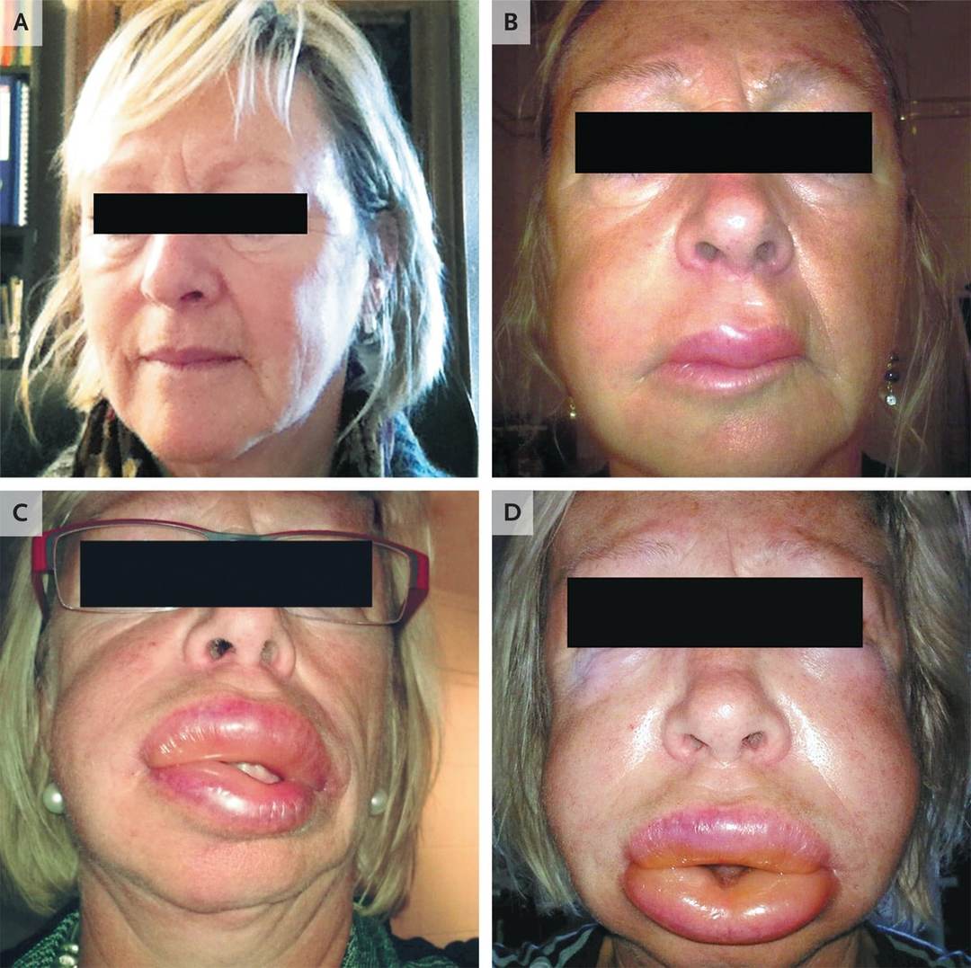 Angioedema: what is it, symptoms, photos, treatment