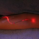 Traitement au laser intraveineux