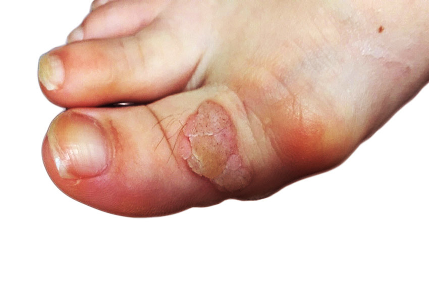 Vulgäre Warzen auf den Händen, Finger, Gesicht oder Fuß - Foto, Behandlung