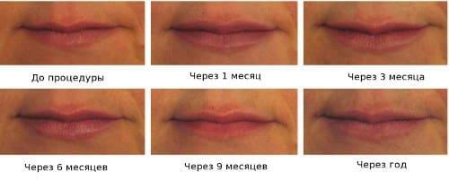 Es tut weh, ob Lippen mit Hyaluronsäure zu erhöhen