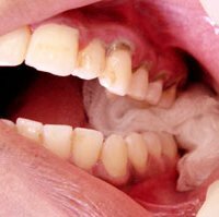 Kako zaustaviti krvarenje nakon ekstrakcije zuba?