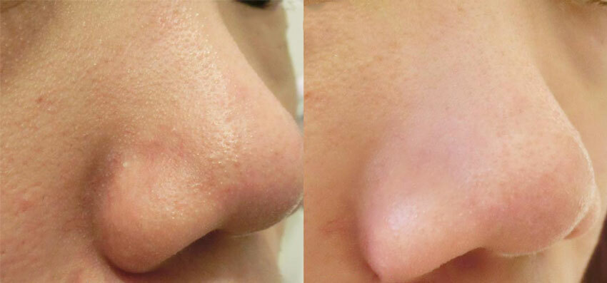 Nettoyage par ultrasons de la peau du visage: étapes de la procédure, photos avant et après