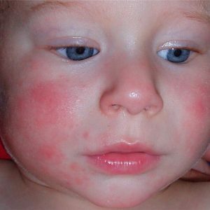 1390491864_аллергииа у лице-у-деце