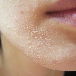 Dry skin of face