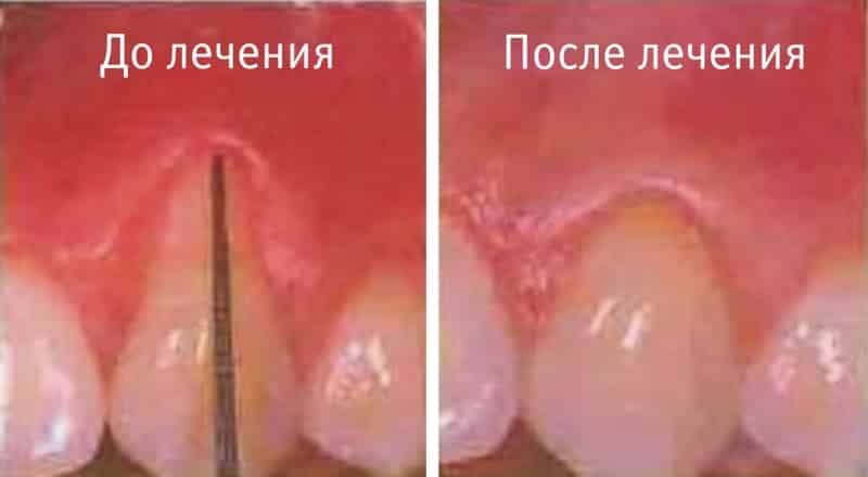 Foto onemocnění parodontu před a po