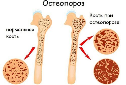 Ременс током менопаузе код жена: шта је због ефикасности