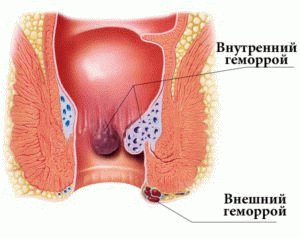 Ungüento para hemorroides Proctoglivenol: revisiones e instrucciones de uso