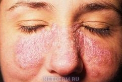 Läsion der Haut mit Lupus