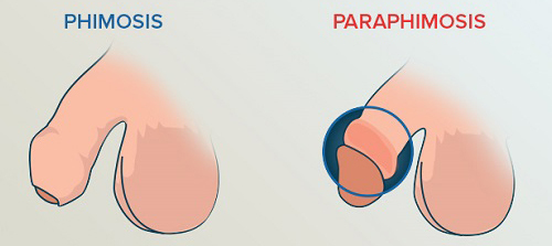 The difference between phimosis and paraphimosis