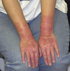 Foto allergia alla lattice