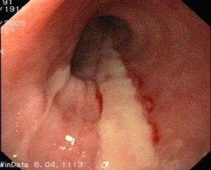 Fibrineuze oesofagitis: oorzaken, graden, symptomen en behandeling