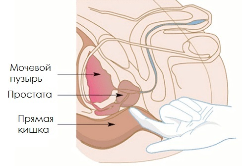 Masáž prostaty s rukami: ako a využívanie