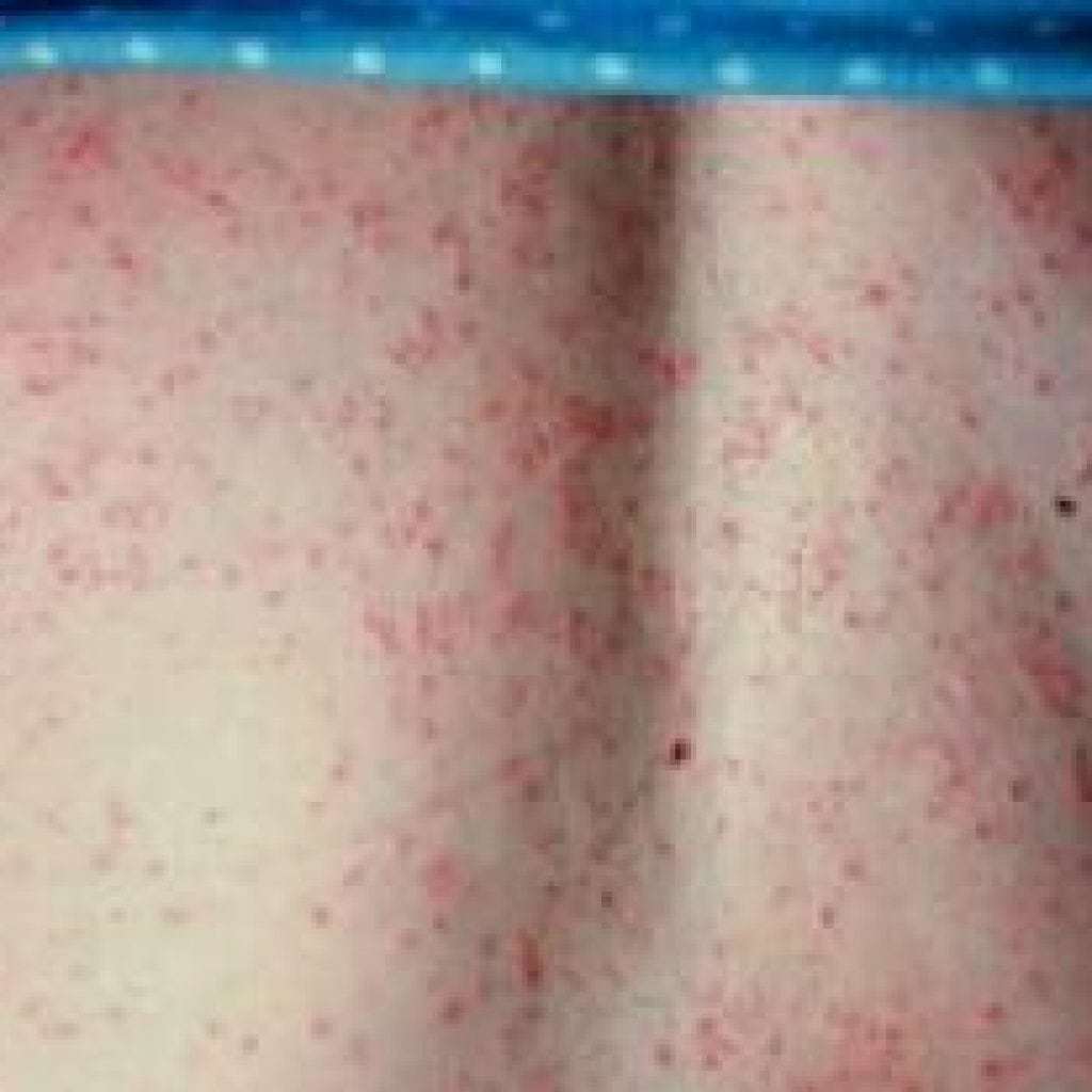 Prickly heat in adults, symptoms and treatment, photos of patients