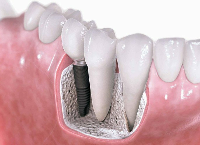 Zahnimplantation. Material und Kosten
