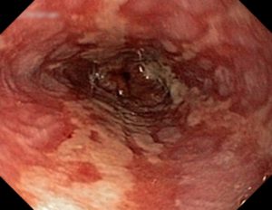Reflux oesophagitis