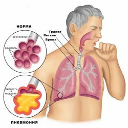 Chronic pneumonia: symptoms, clinical picture, treatment