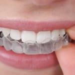 Ist es möglich, ohne Klammern zu begradigen Zähne