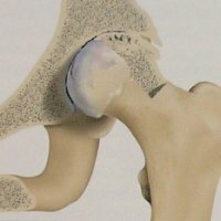 Osteoarthritis of the hip joints