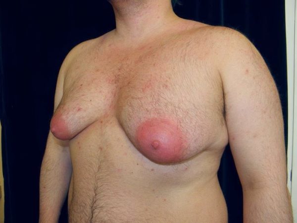 Iekaisums krūts dziedzeru vīriešiem: simptomi mastītu un tā variantus, ārstēšana