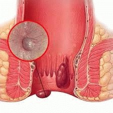 Ontsteking van de hemorrhoidale aderen