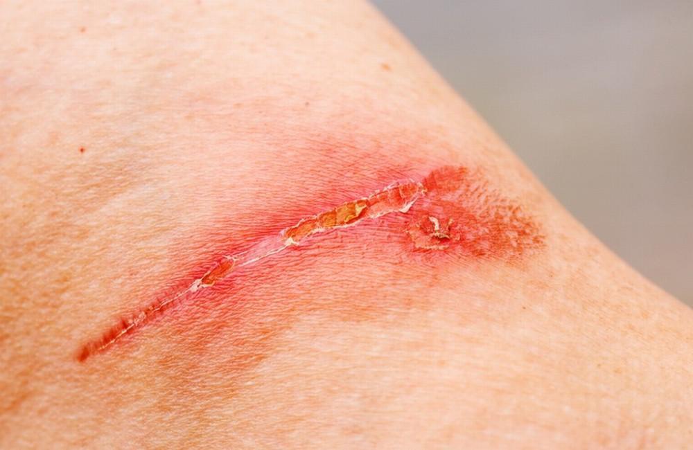 Purulent wound on the leg