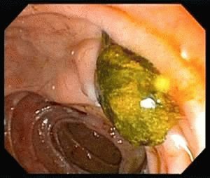 Pancreatitis infectie