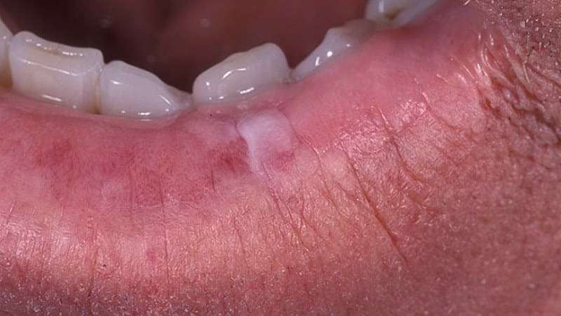 leukoplakia dalam foto mulut