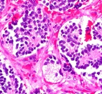 Slike nevroblastoma